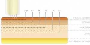 dermapen-electric-needle-diagram-300x151